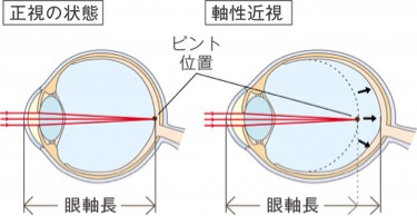 性 乱視 近視